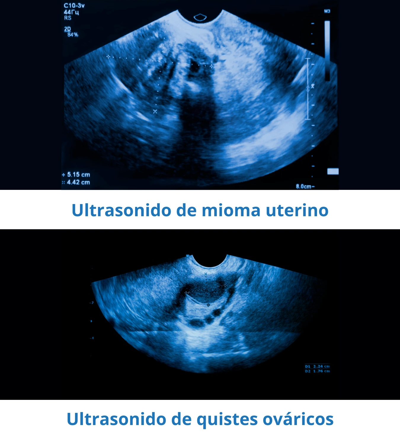 Ultrasonidos de miomas y quistes para su análisis e identificar el tratamiento adecuado para cada caso.