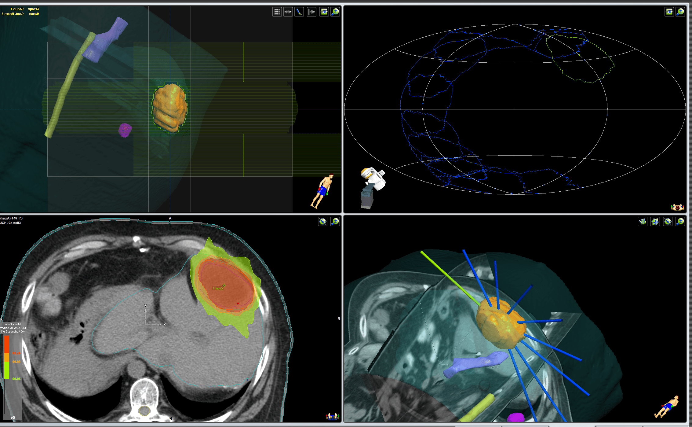 radiografia de tumor en el higado.