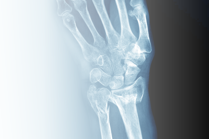V Curso de Cirugía de Mano: Trauma esquelético para el cirujano de mano.