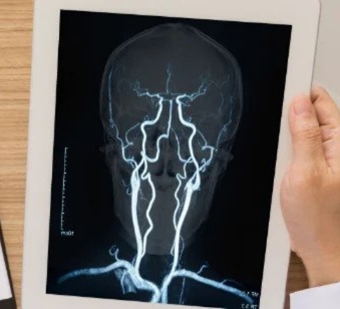 <strong/>Enfermedad cerebrovascular- ICTUS