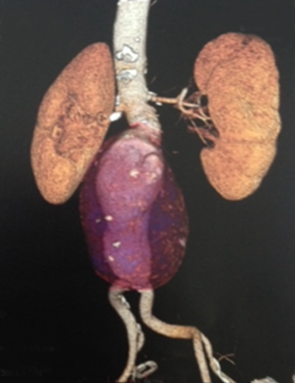 Angiotomografía aneurisma de aorta abdominal