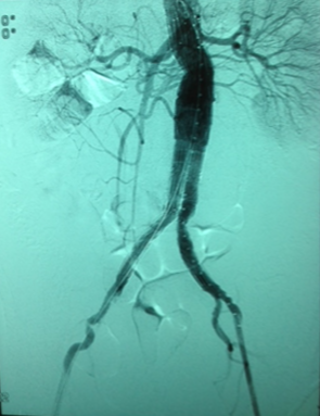 Angiotomografía posterior al tratamiento 