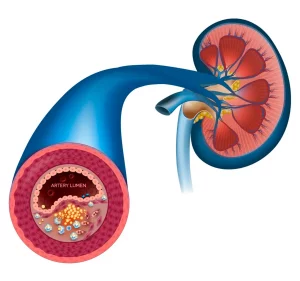 Dibujo de enfermedad renovascular donde se presenta estenosis de la arteria renal (arteria estrechada) y hay reducción del flujo sanguíneo.