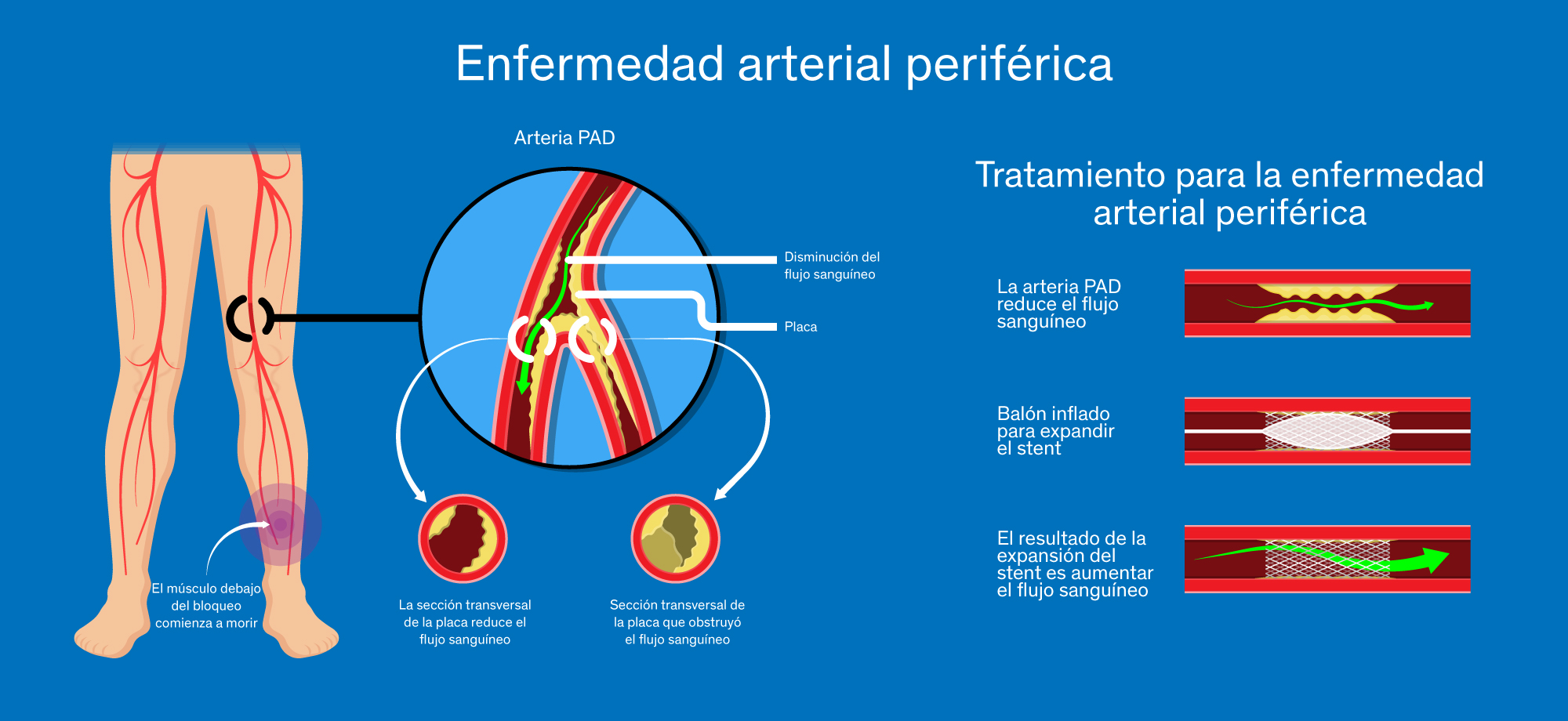 Diagrama sobre la enfermedad arterial periférica, donde se explica cómo la placa obstruye la arteria y cómo funciona el tratamiento para esta condición.