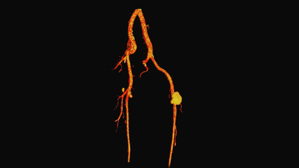 Dibujo que representa un aneurisma periférico en una de las arterias que están en las extremidades de una persona. 