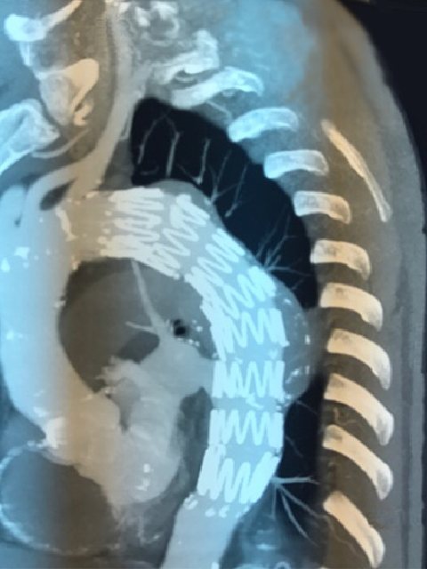 Procedimiento endovascular