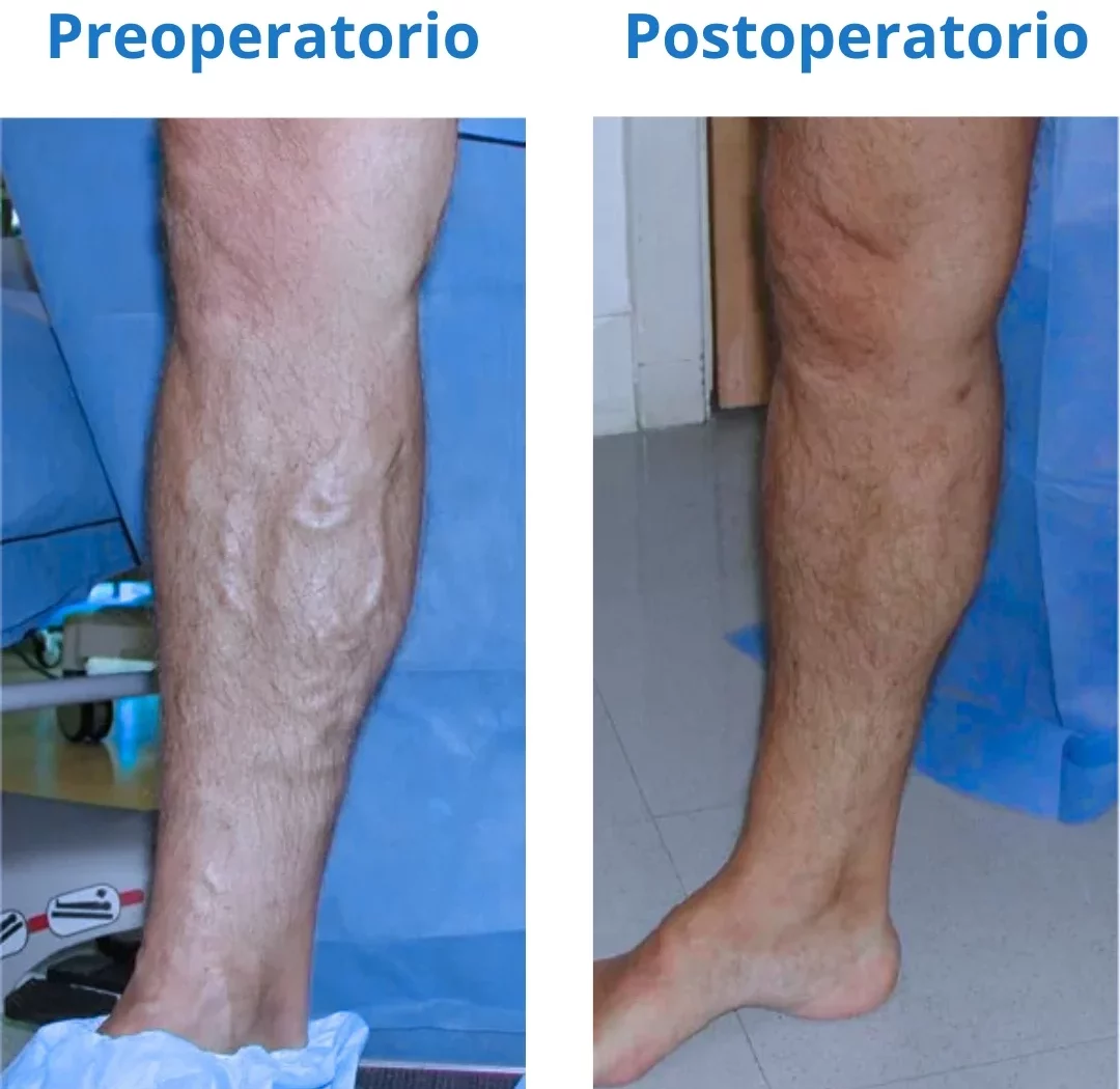 Pierna de hombre que presenta insuficiencia venosa crónica, la imagen de la izquierda es en su etapa preoperatoria y la de la derecha es postoperatoria.