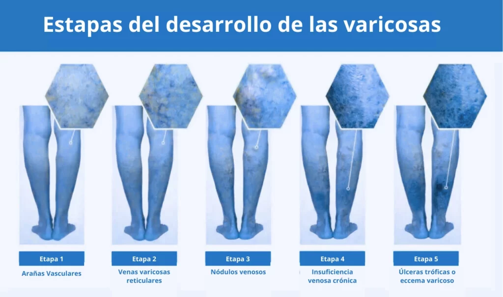 Imagen de las etapas de la insuficiencia venosa crónica, donde se señala el nombre de cada una de ellas en unas piernas.