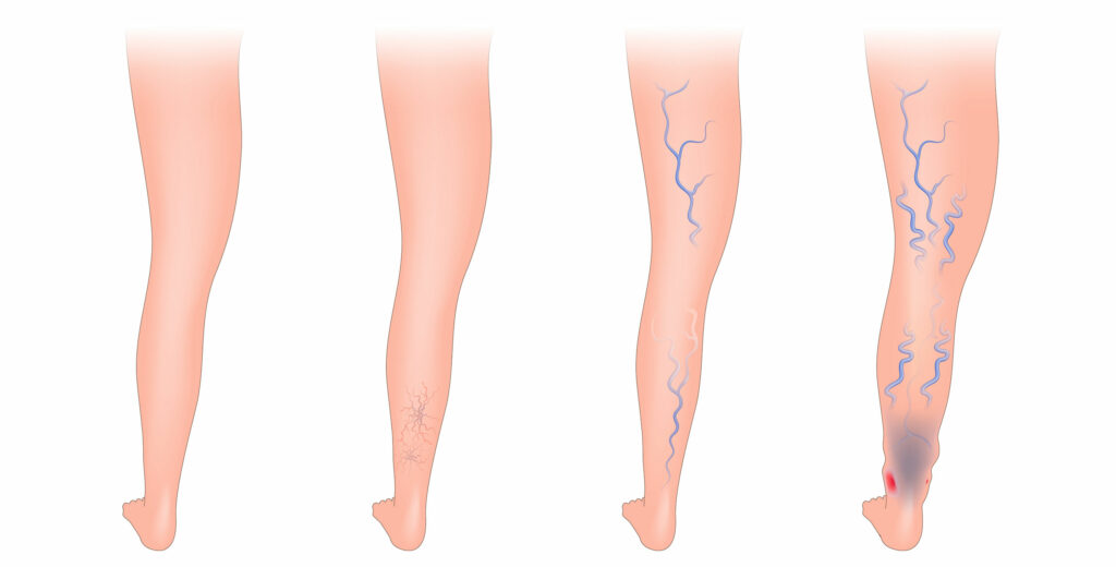 Dibujo de piernas, donde se representa qué es una úlcera varicosa y los diferentes grados en los que se puede presentar.