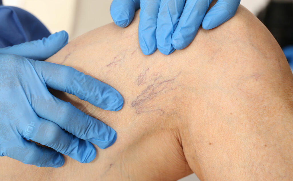 Médico revisa la pierna de un paciente, donde se marcan las venas, para identificar si hay úlceras venosas.