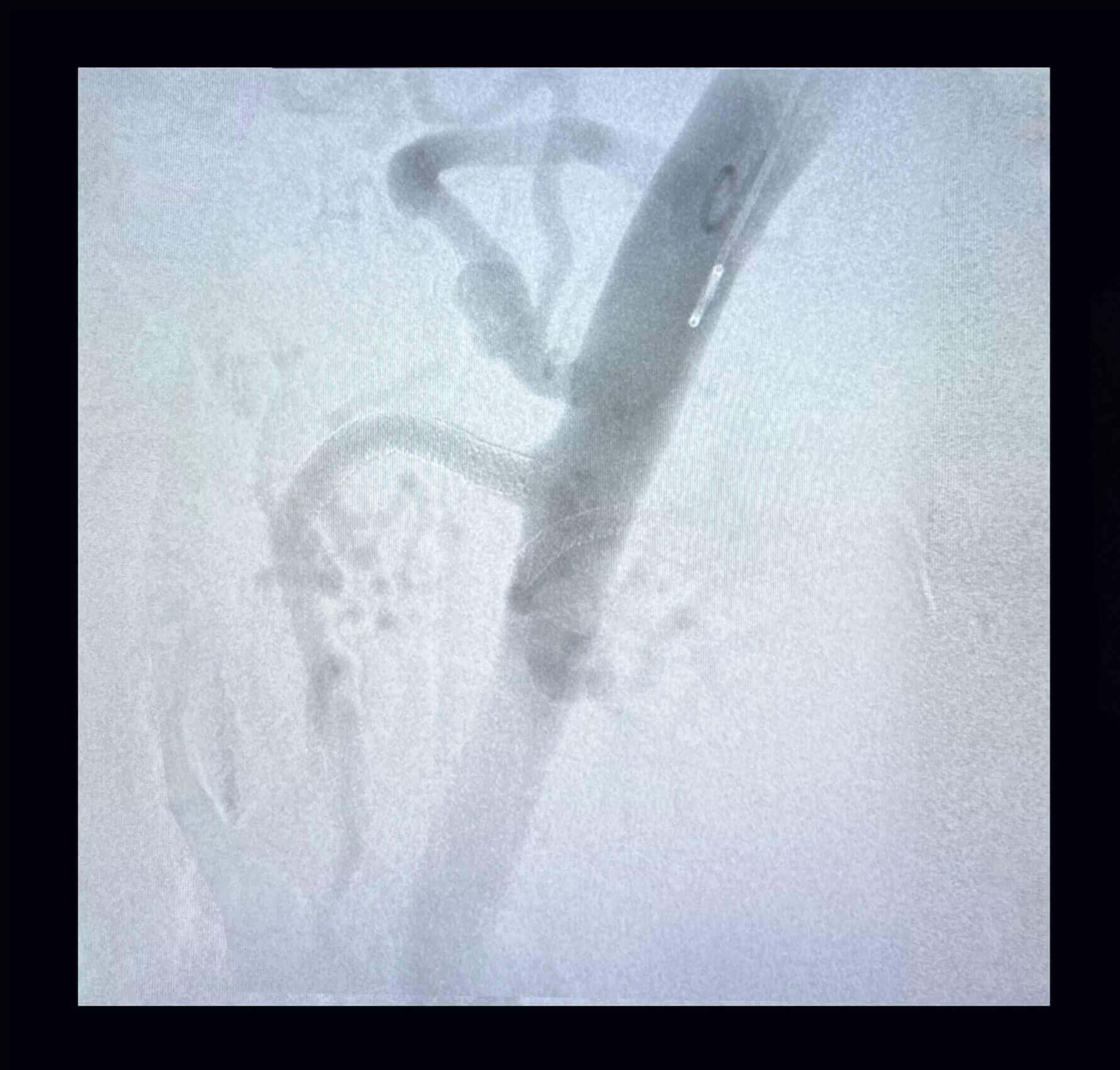 Aneurismas de arterias periféricas