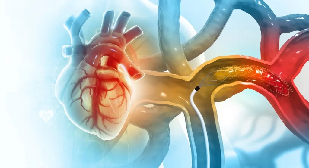 Dibujo que representa lo que es un cateterismo cardíaco, en donde el catéter se mueve por las arterias para llegar al corazón.