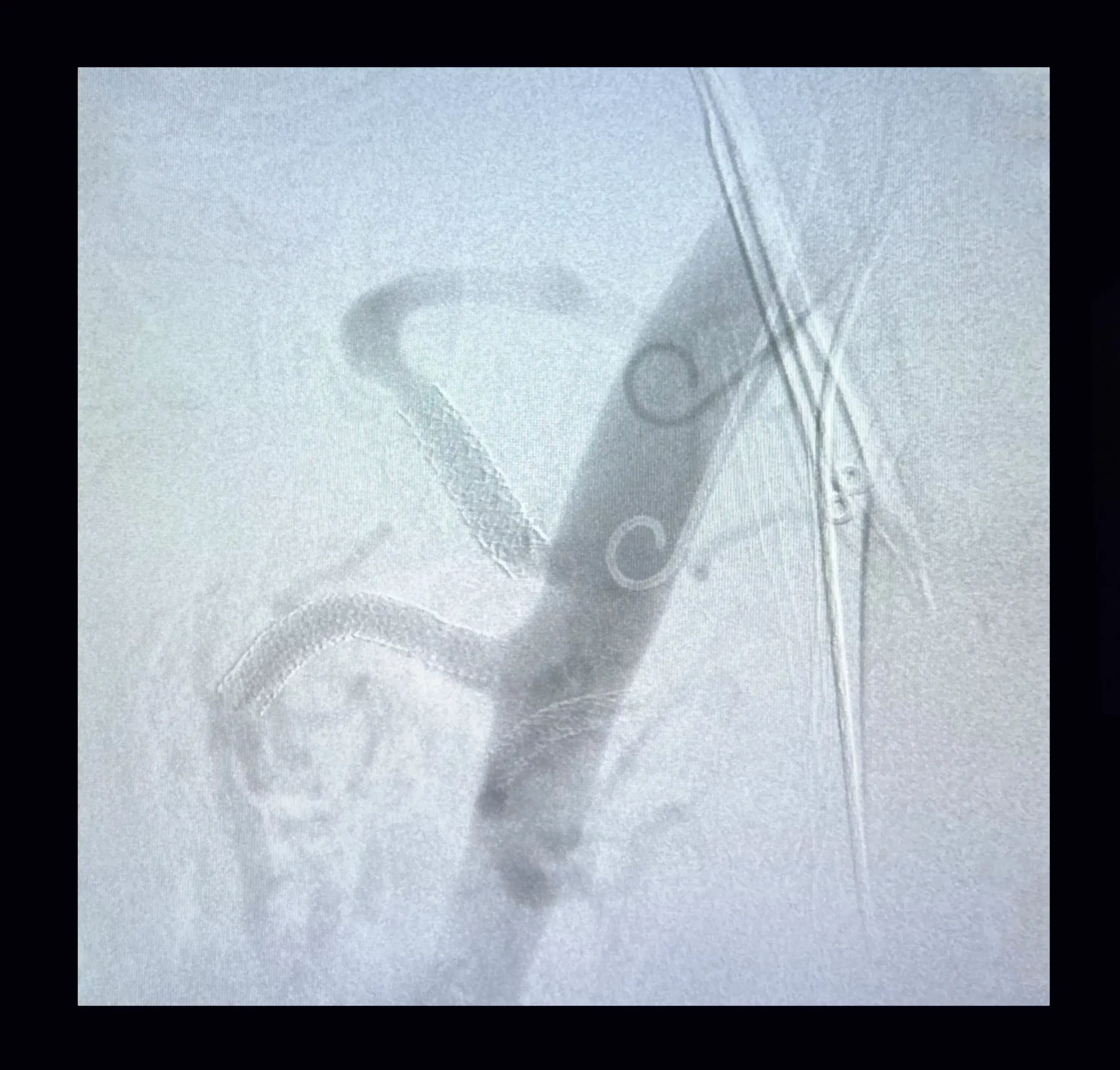 Aneurismas de arterias periféricas