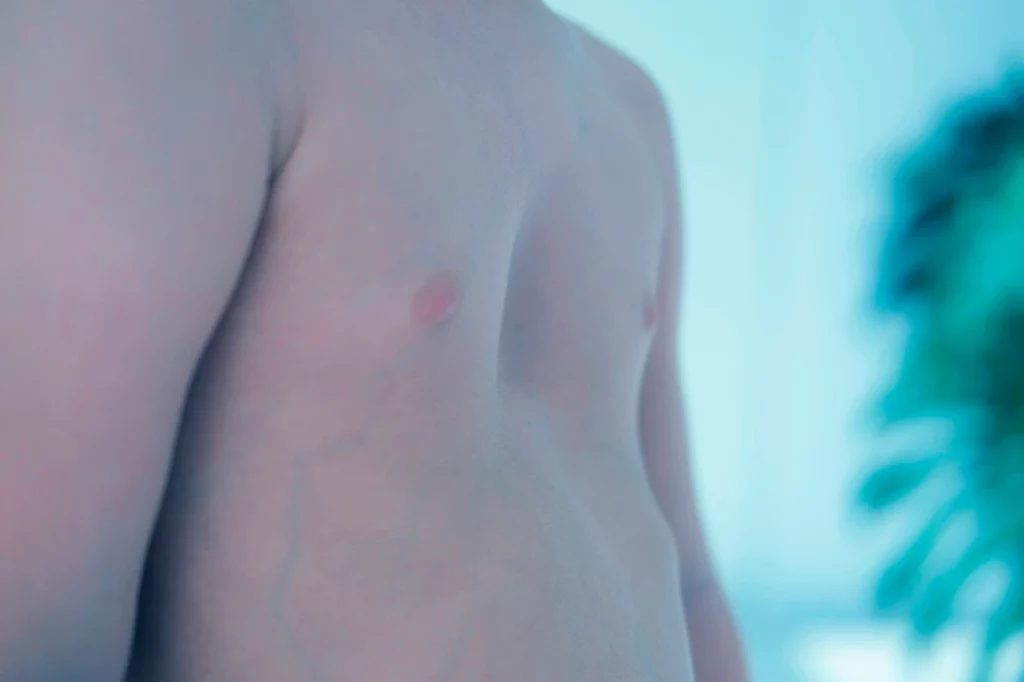 Chest of a child with pectus excavatum.