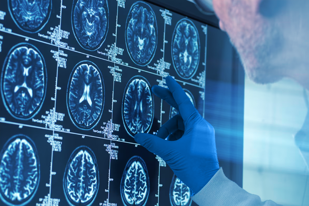 Doctor’s hand in front of brain CT scan images while analyzing the presence of neurocysticercosis.