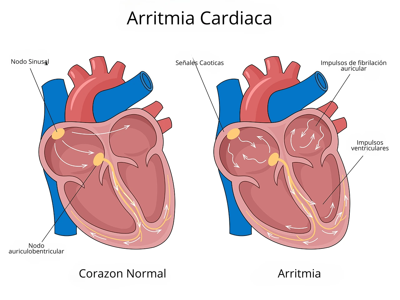 Diagrama comparativo de corazones: normal vs. con arritmia | Clínica de arritmias. Representación visual que muestra la diferencia entre un corazón con ritmo normal y otro con arritmia, destacando variaciones en la actividad eléctrica y latidos irregulares.