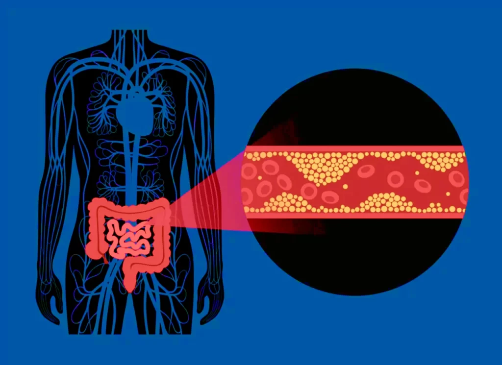 Dibujo un cuerpo donde se marcan el intestino grueso y delgado, con una imagen aumentada que ejemplifica la trombosis venosa mesentérica.