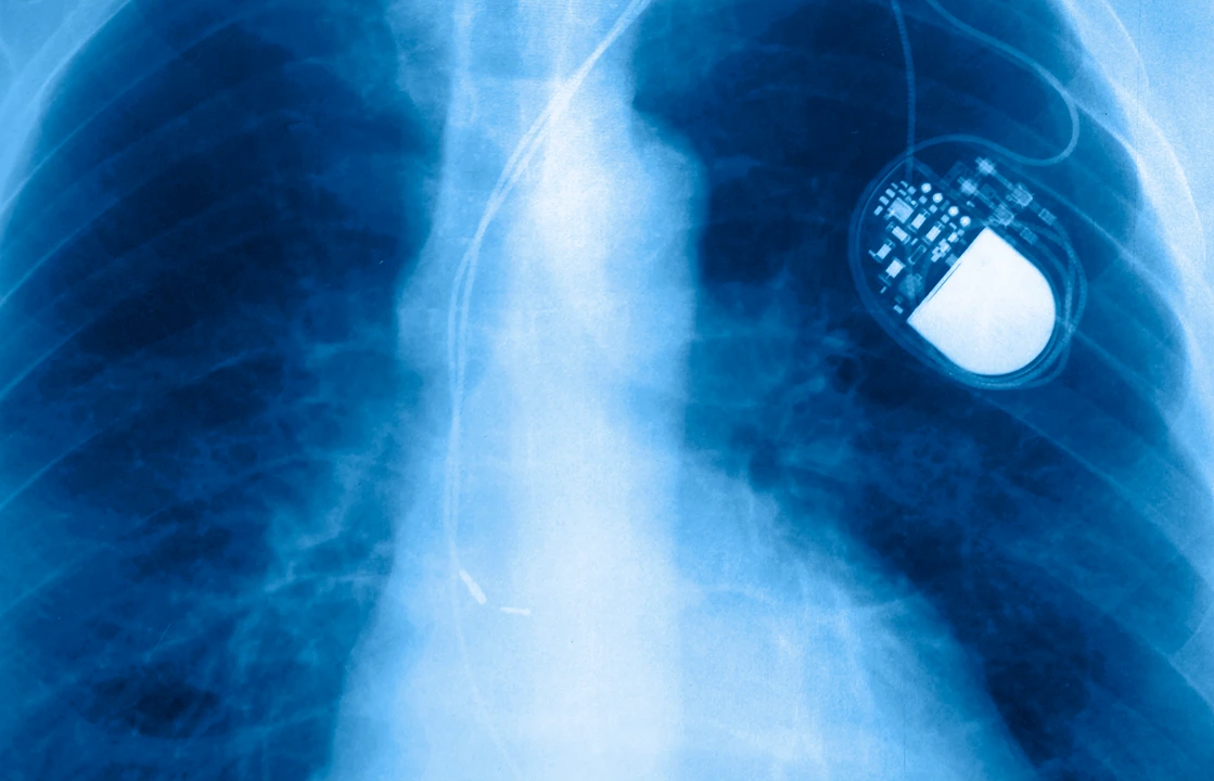 Radiografía del torso de una persona, donde se visualiza lo que es un marcapasos que se le ha colocado.