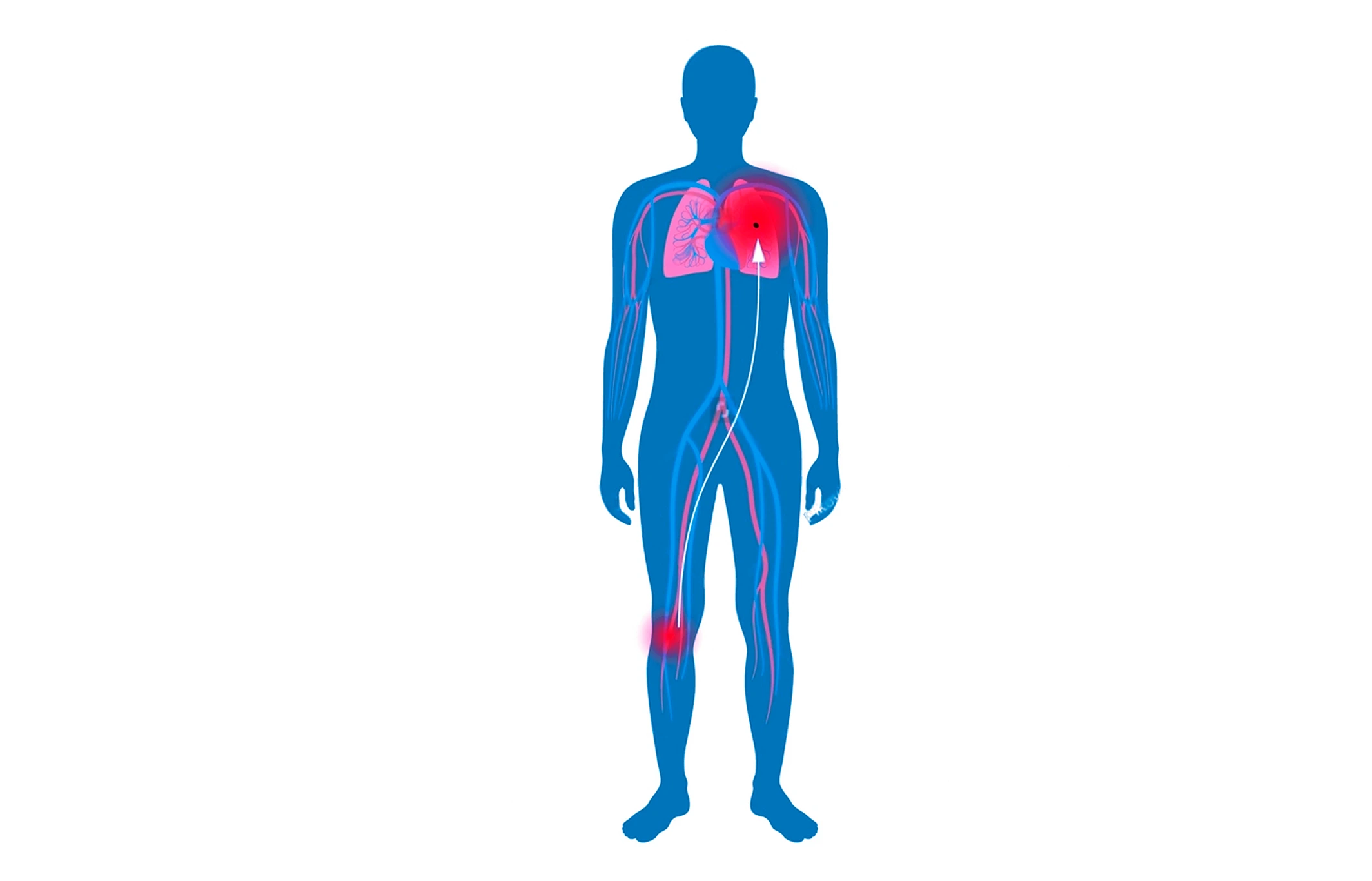 Dibujo que simboliza cómo una trombosis venosa profunda afecta las venas de las piernas y los pulmones.