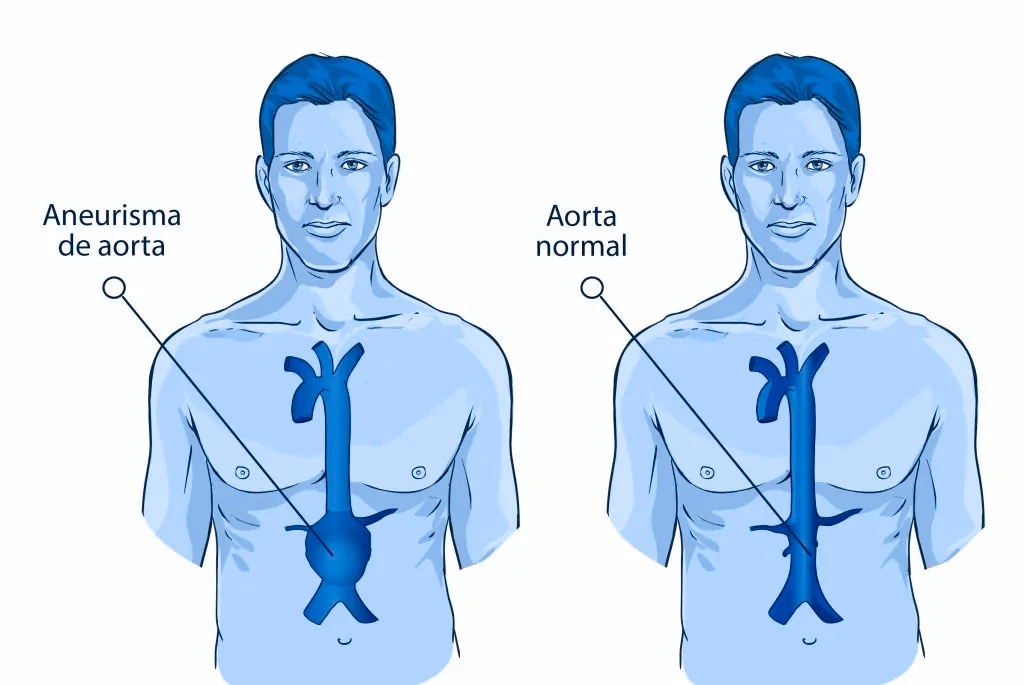 Dibujo para comparar cómo se presenta un aneurisma de aorta abdominal en comparación de una persona con aorta normal