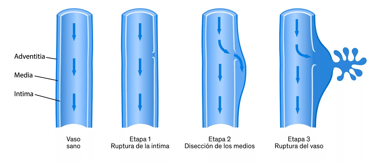 Dibujo que representa la disección aórtica a través de las etapas de ruptura de un vaso sano.