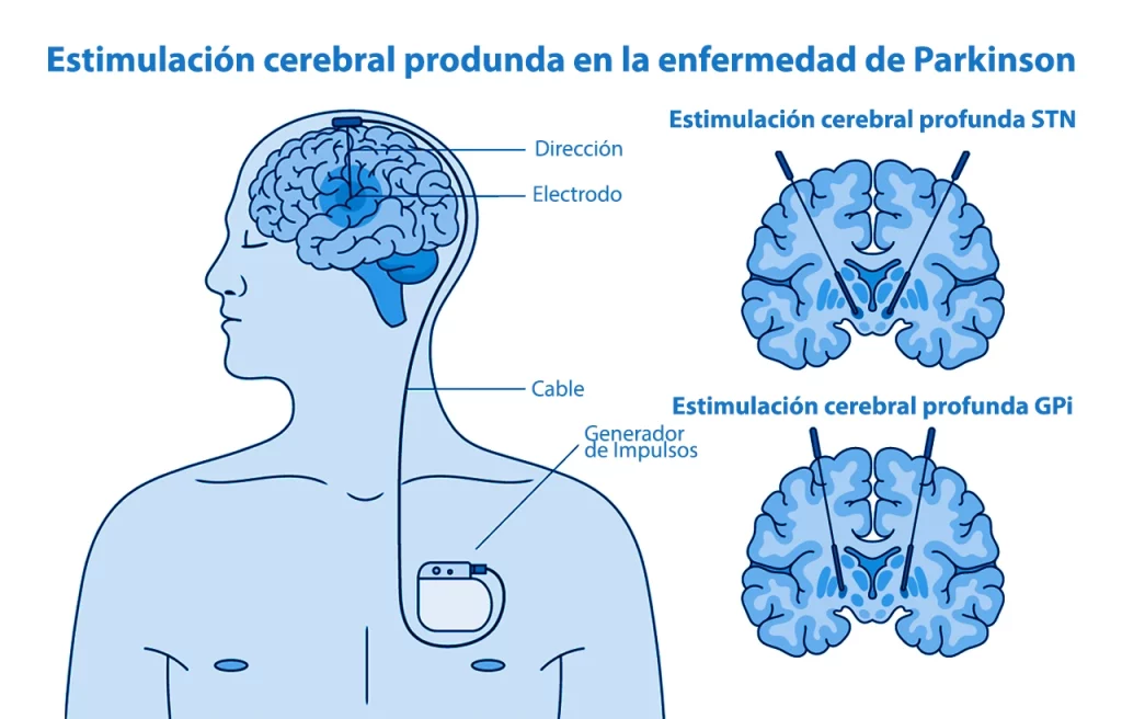 Dibujo que representa la estimulación cerebral profunda en la enfermedad de Parkinson con sus variantes STN y GPi.