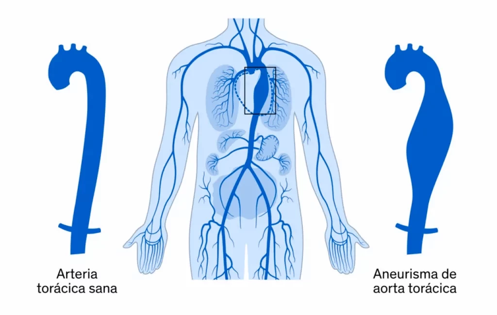 Dibujo sobre el aneurisma de aorta torácica, donde se ve un cuerpo y se representa como es una arteria sana y otra enferma.
