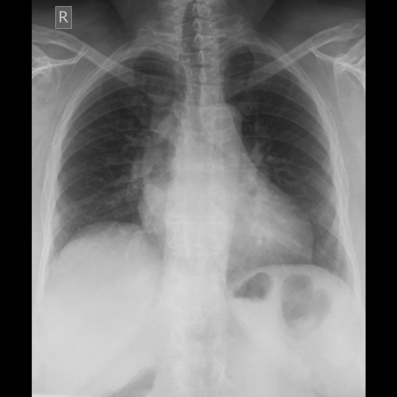 Radiografía de un paciente que presenta corazón dilatado o cardiomegalia.