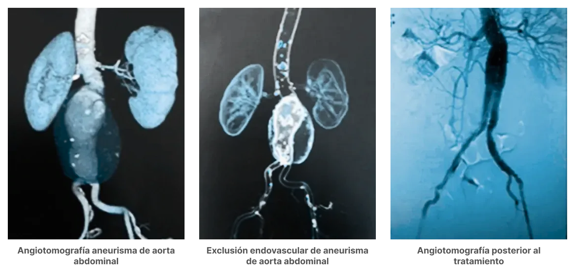 Tres imágenes que permiten conocer cómo es una aneurisma de aorta abdominal para su estudio y diagnóstico.