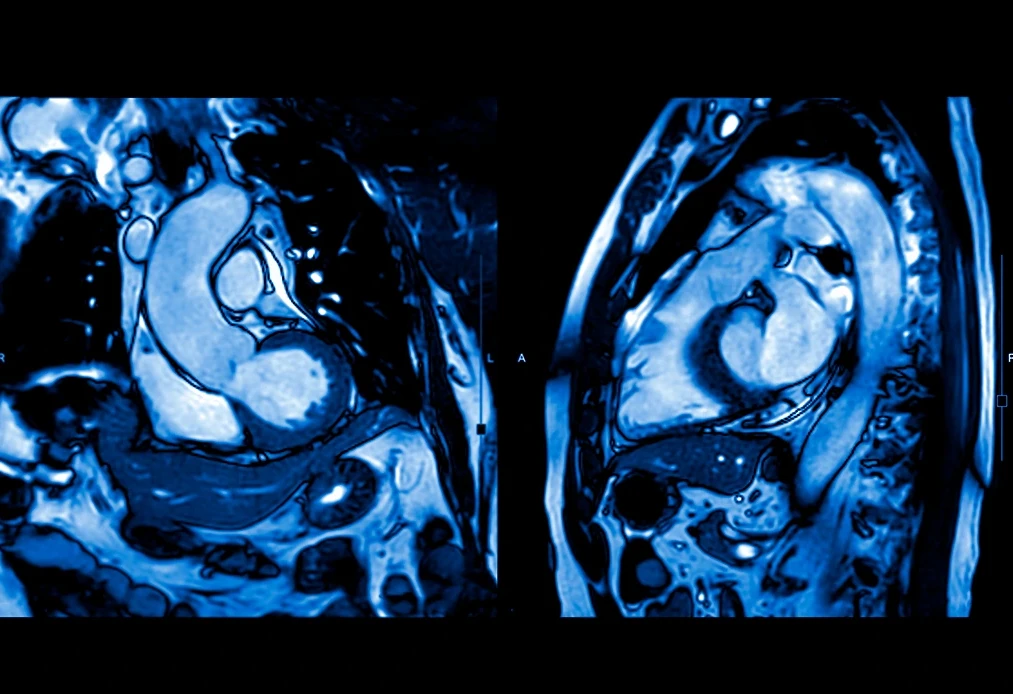 Imagen de una resonancia magnética cardiaca del ventrículo izquierdo y derecho para el diagnóstico de una condición cardíaca.
