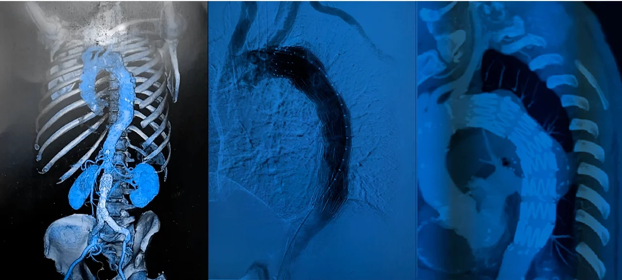 Ejemplos de cómo se visualiza el aneurisma de aorta torácica a través de diversos estilos de imagen y estudios.