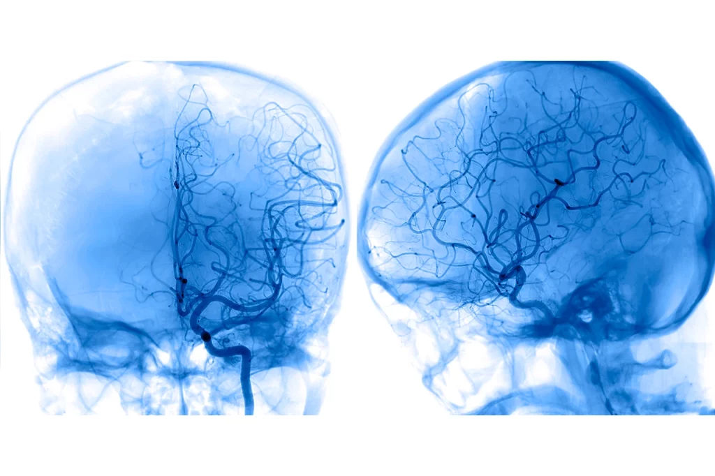  Imagen de una angiografía cerebral con fluoroscopia que permite visualizar una arteria cerebral.