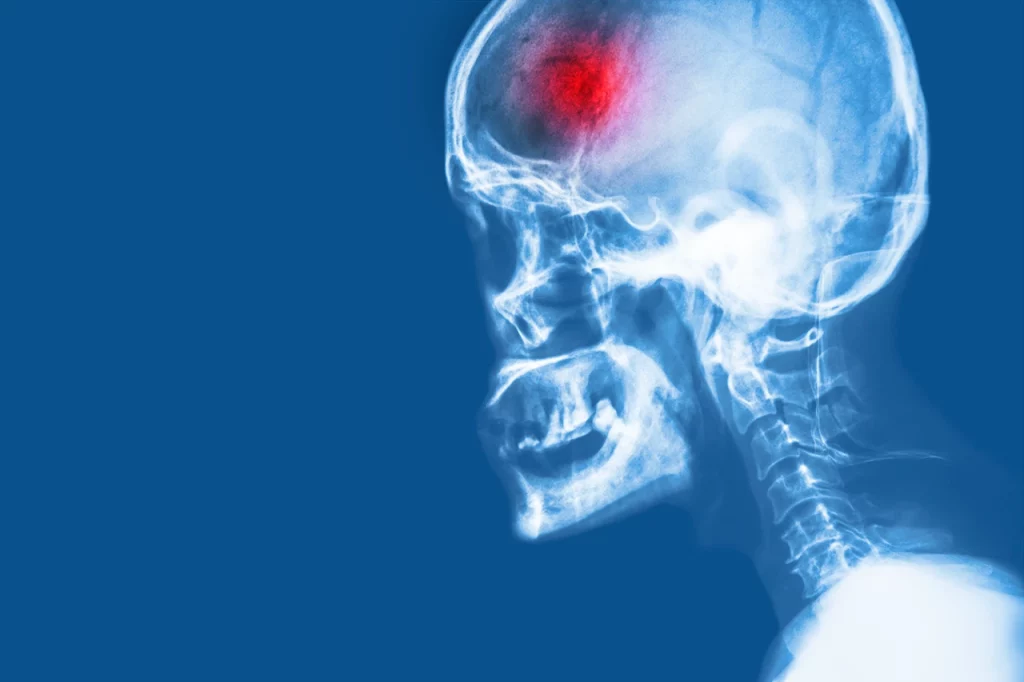 Radiografía de paciente con isquemia cerebral, donde se marca el área del cerebro que se está viendo afectada por esta condición.