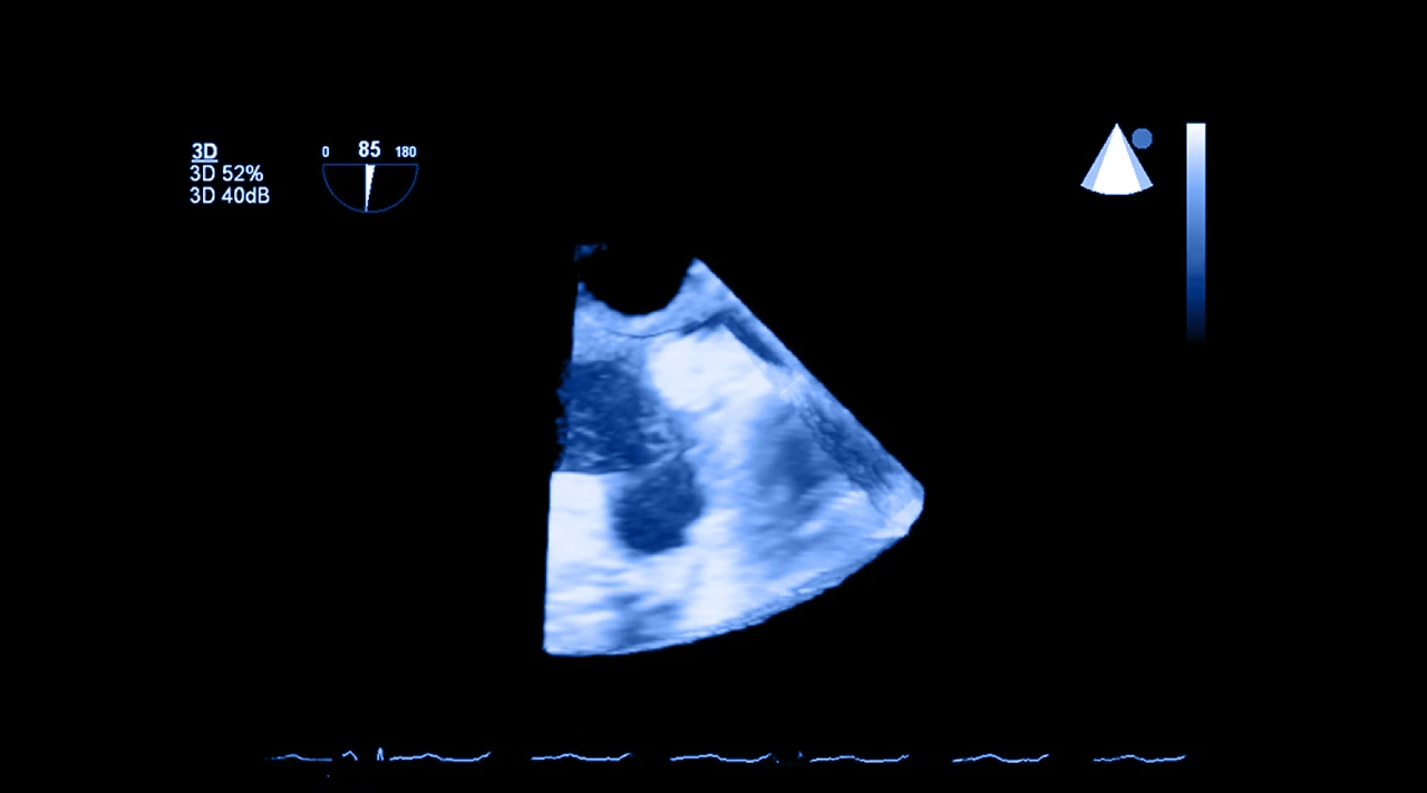 Imagen resultante de un ecocardiograma tridimensional mediante un ultrasonido transesofágico.