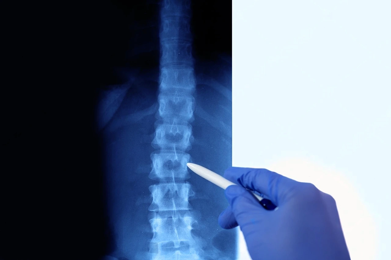 Médico analizando la presencia de alteraciones posturales en un paciente a través de una radiografía, y señalando con un bolígrafo el área afectada.