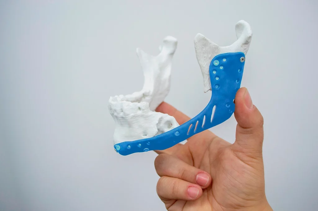 Impresión 3D para reemplazo de quijada en una próxima cirugía ortopédica que recibirá un paciente.