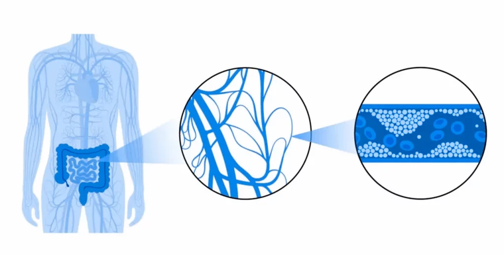 Dibujo que representa cómo se desarrolla la isquemia mesentérica, afectando a las venas y arterias de los intestinos.