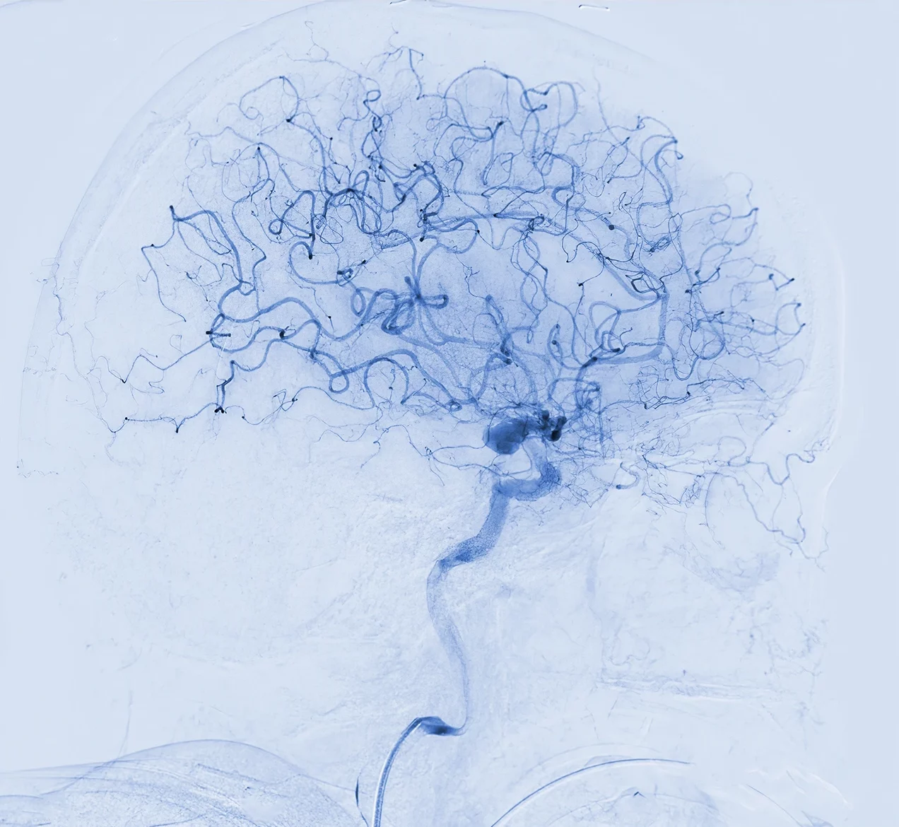 Angiografía del cerebro para identificar la presencia de un aneurisma.
