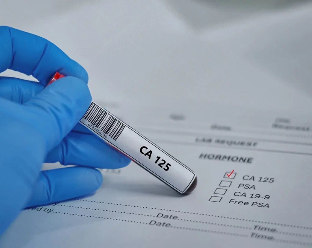 Tubo de ensayo para realizar la prueba de antígeno tumoral CA-125 para detección de cáncer de ovario.