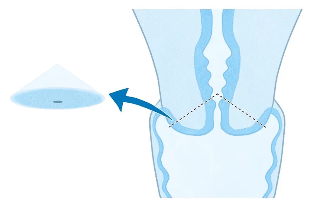 Dibujo que representa la conización cervical o biopsia de cono para abordar lesiones cervicales en una mujer.
