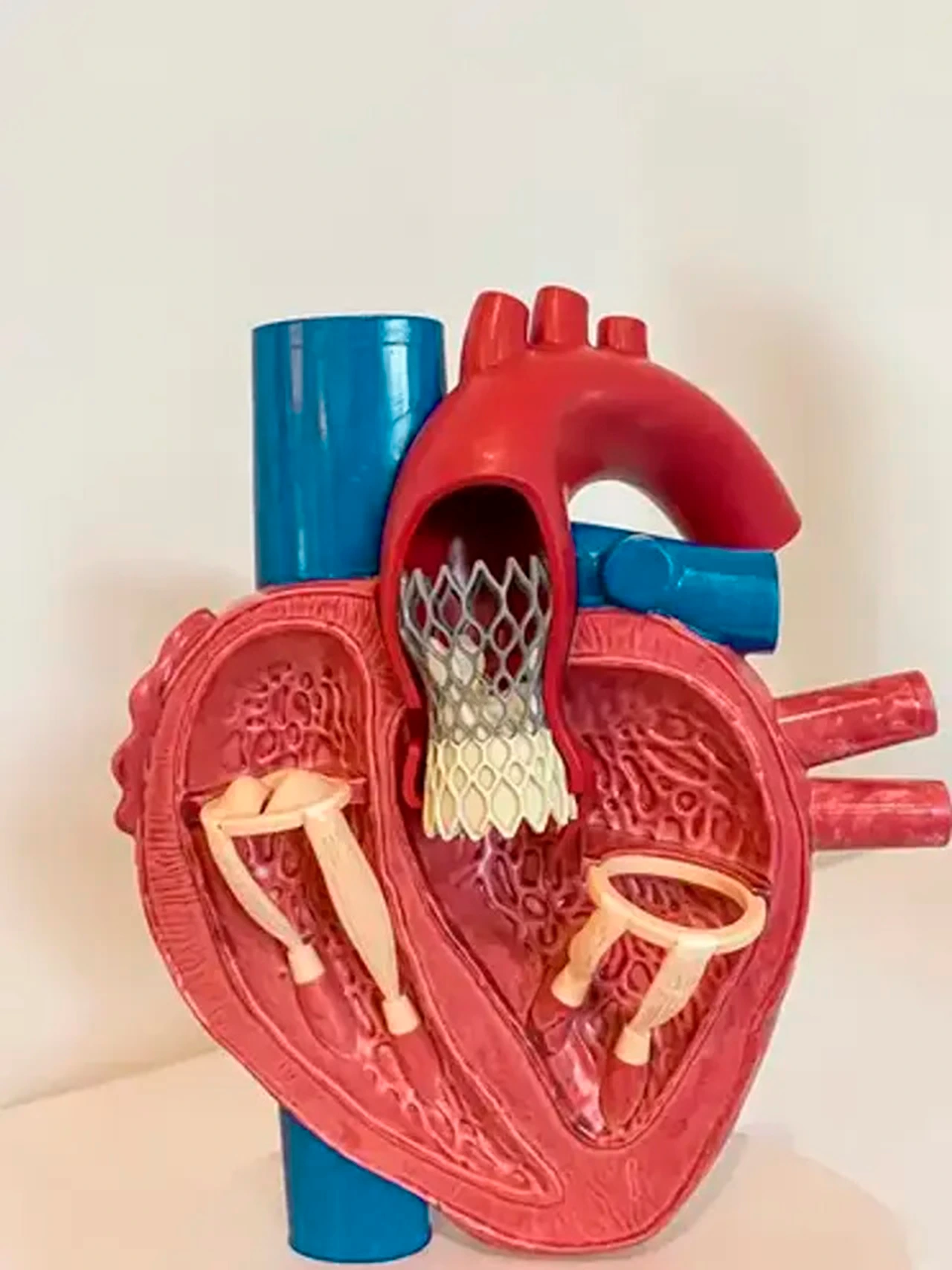 Modelo de un corazón para ejemplificar como se ve el procedimiento TAVI una vez se ha realizado en el paciente.